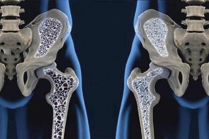 Osteoporose x Artrose: Rivais ou Parentes? Entenda o que as diferem!